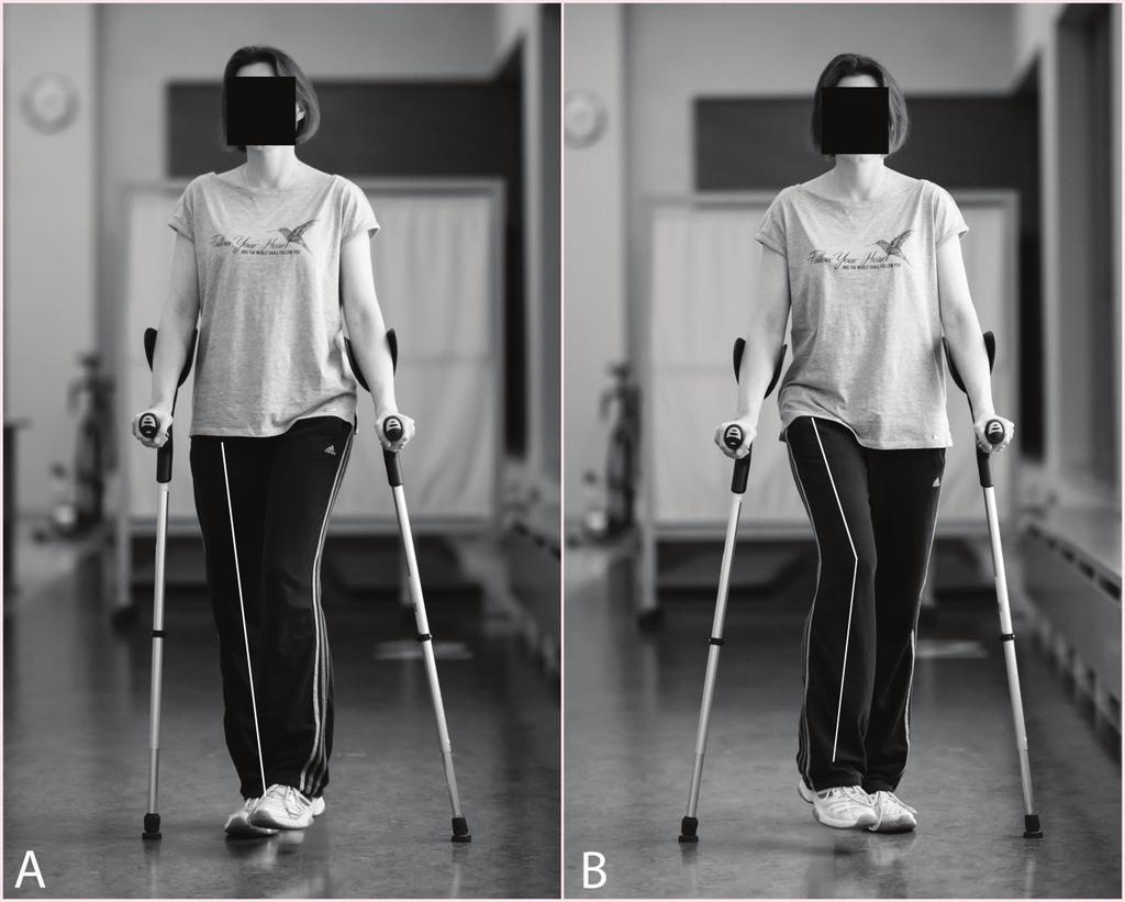 Advances in Rehabilitation/Postępy Rehabilitacji (1), 21 30, 2018 23 surgery and to determine factors which affect this knowledge. Material and methods The research included 31 patients, i.e. 16 men and 15 women after total hip arthroplasty (mean age 57.