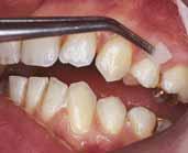 kamienia nazębnego powierzchni zębów po ich opracowaniu i/lub szlifowaniu startych powierzchni okluzyjnych oraz zębów z umieszczonymi na nich klamrami po urazach szkliwa (np.