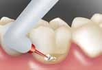 szyjek zębów i brzegów koron Znoszenie nadwrażliwości w obszarze szyjek po profesjonalnym oczyszczaniu oraz usuwaniu kamienia