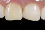 estetyki Szynowanie rozchwianych zębów Naprawa licówek Wypełnienia zębów mlecznych Odbudowa rdzenia pod korony protetyczne Wkłady koronowe Naśladujący tkanki zęba materiał do wykonywania