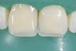 wtórną konieczna jest wymiana wypełnień w zębach 14 i 15 Źródło: Dr.