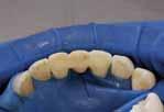 ekstrakcji z zastosowaniem zęba sztucznego Tymczasowe i tymczasowe długoczasowe uzupełnienie luki z zastosowaniem usuniętego zęba