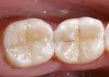 Licowanie przebarwionych zębów przednich Korekta kształtu i koloru w celu polepszenia estetyki Łączenie ze sobą i szynowanie rozchwianych zębów Naprawa licówek, małych defektów szkliwa oraz koron i