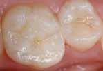 czas pracy czas wiązania indywidualnie dostosowany dzięki polimeryzacji światłem Brak konieczności kondycjonowania tkanek zęba Nadaje się również do dużych ubytków Można kondensować zaraz po