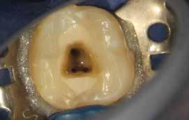 Praktyka _ Endodoncja Ryc. 2a-e_Leczenie kanałowe pierwszego zęba trzonowego żuchwy oraz stosowanie H-LAI z końcówką X-Pulse wykazują swoją skuteczność w opracowaniu kanału (a. dostęp do ubytku, b.