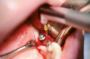 Periimplantitis jest opisywane jako dalsza progresja akumulacji płytki i stopniowego rozprzestrzenianie się zakażenia bakteryjnego na kość otaczającą implant, charakteryzuje się pozapalną destrukcją