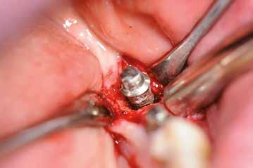 - Po 10 latach u 1 na 5 pacjentów rozwija się periimplantitis.