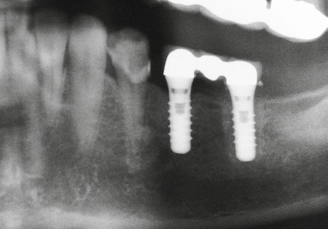 Praktyka _ Perimpantitis Ryc. 18 Ryc. 18_Pooperacyjne sprawdzenie po odkażeniu em i augmentacji defektu biomateriałem rozmiaru 0,25-1 mm Bio-Oss oraz zakryciem błoną Bio-Gide efektem zgrzewania.