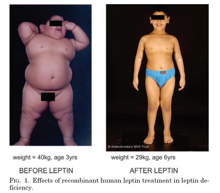 Child with a mutation in leptin