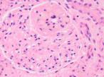 Cukrzyca (diabetes mellitus) Złożona choroba przemiany materii; choroba metaboliczna, której objawem jest