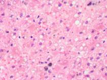 nerczycowy (syndroma nephroticum) - znaczna proteinuria, hipoalbuminemia, uogólnione obrzęki, hiperlipidemia