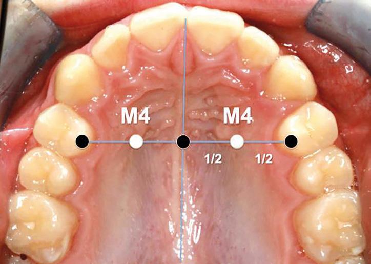 Od 2005 roku mini-implanty ortodontyczne (z ang. Orthodontic Mini-Implants OMI) stały się podstawową częścią koncepcji leczenia ortodontycznego.