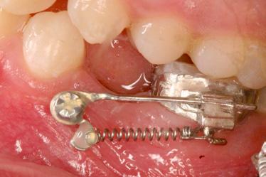 zapewnia odporne na rotacje połączenie pod określonym kątem między mini-implantem a zębem