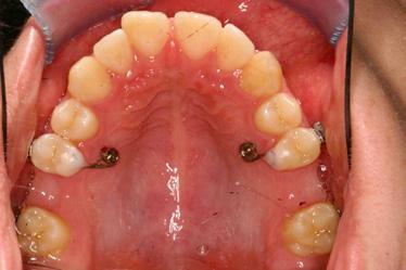 Implant ortodontyczny Dual-Top (JS, JA i G2) działa jak bezpieczna i trwała kotwica.