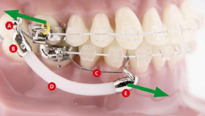 Dodatkowym wskazaniem jest zamykanie przestrzeni w żuchwie, zwłaszcza po ekstrakcji lub ze względu na wrodzony brak zębów.