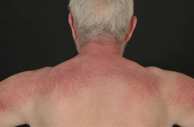 Poikilodermia