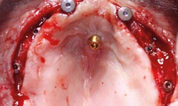 Stimmelmayr, periodontolog Cham, Niemcy Cel: Zwiększenie grubości tkanek miękkich wokół implantów