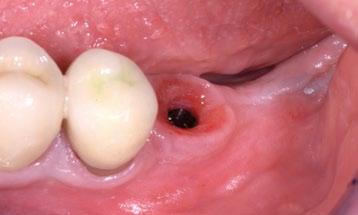 tkanek miękkich wokół implantów stomatologicznych.