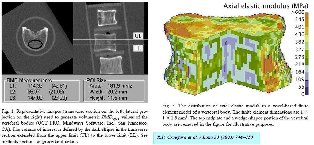 BADANIA OBRAZOWE Ilościowa tomografia komputerowa (QCT) Uzyskane pomiary są komputerowo przetwarzane na obraz i jednocześnie porównywane ze wzorcem jakim jest dla tkanki kostnej fosforan