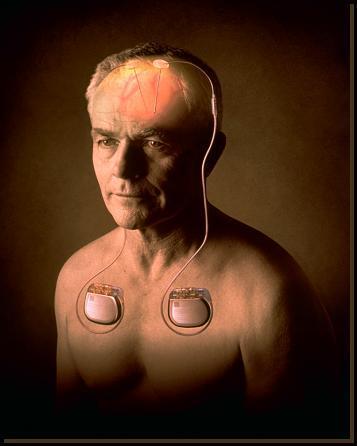 Techniki neuromodulacji -