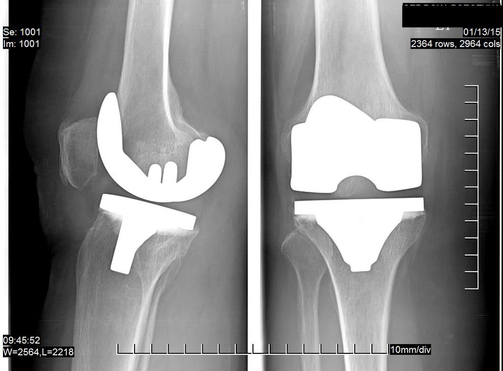 Przypadki kliniczne II Kobieta w wieku 63 lat Pierwotna