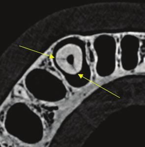J Stoma 2016; 69, 1 Armata O., Bołtacz-Rzepkowska E. Fig. 4. Axial slice of tooth No. 8 without root canal filling VRF visible.