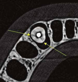 Przekrój czołowy zęba nr 8 z wypełnieniem w kanale widoczna szczelina złamania. Fig. 6. X-ray of tooth No. 8 without root canal filling VRF not visible.