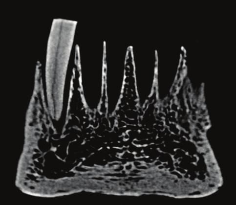 Diagnostic value of Cone-Beam Computed Tomography in diagnosing... J Stoma 2016; 69, 1 Fig. 8. Frontal slice of tooth No. 12 without root canal filling VRF clearly visible.
