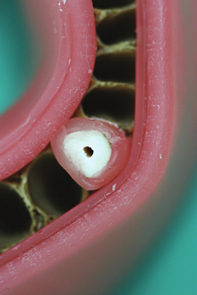 Diagnostic value of Cone-Beam Computed Tomography in diagnosing... Fig. 1.