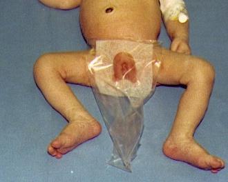 Badanie mikrobiologiczne moczu Próbka pobrana do woreczka: Wynik ujemny pozwala na wykluczenie ZUM Wynik dodatni nie pozwala ani