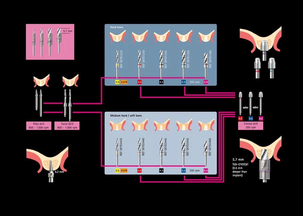 SKY Implant System Procedura chirurgiczna: 5.2mm Łoże 5.