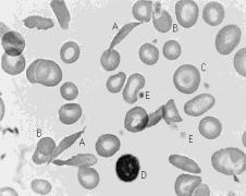 mikroangiopatyczne, ostre zatrucia, wady serca, oparzenia II i III