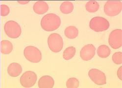 hemoglobinopatie (talasemia), po splenektomii, żółtaczka