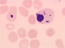 barwią się błękitem pruskim na fioletowo - występują : talasemia, hemoglobinopatie, MDS WTRĘTY CZERWONOKRWINKOWE WTRĘTY CZERWONOKRWINKOWE Niedokrwistść Stan, w którym dochodzi do obniżenia poniżej