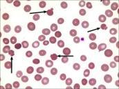 normoblastyczna RDW N MCV N lub N lub Hepcydyna Wskaźniki hemolizy obniżenie stężenia HGB (niedokrwistość normochromiczna) czas przeżycia erytrocytów - skrócony zwiększenie stężenia bilirubiny wolnej