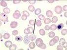 foliowego synteza DNA (przy zachowanej syntezie RNA) zaburzenia dojrzewania jądra zaburzone dojrzewanie komórki macierzystej ukierunkowanej HGB, HCT, RBC - odnowa megaloblastyczna makrocytoza - MCV