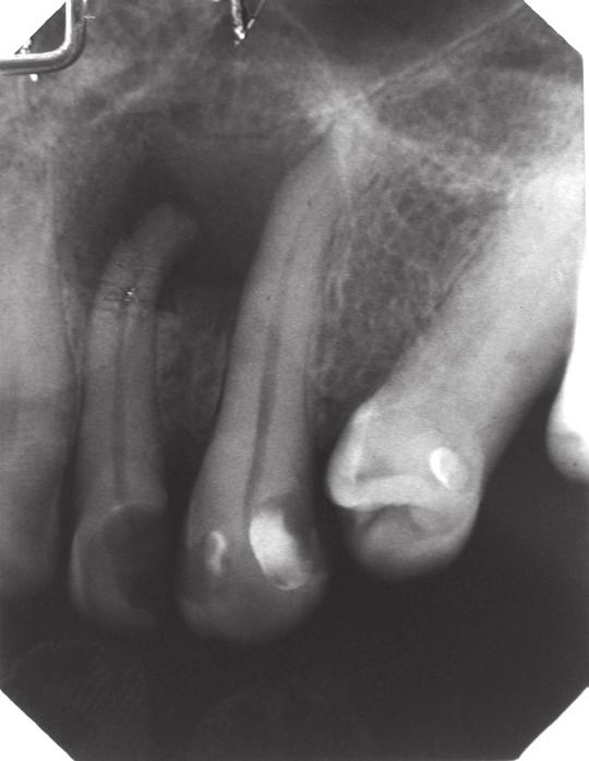 Atypical healing of periapical lesions report of three clinical cases J Stoma 2016; 69, 1 Fig. 1. Tooth 22 before treatment. Ząb 22 przed leczeniem. Fig. 2. Tooth 22 after root canal therapy.