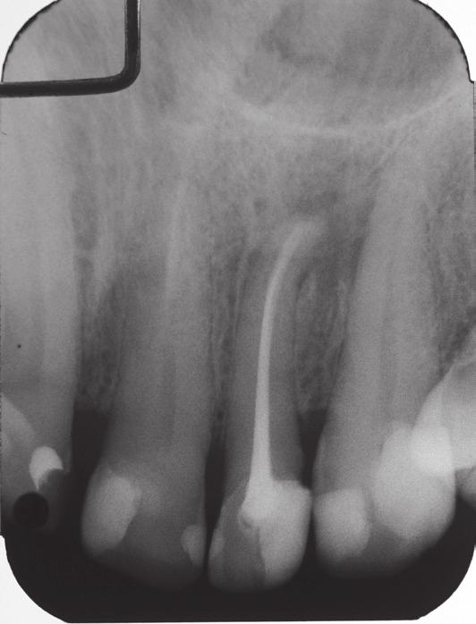 5) latach od wypełnienia kanału obserwowano poreceded but did not heal completely. The tooth was monitored clinically and radiographically for the following eighteen years.