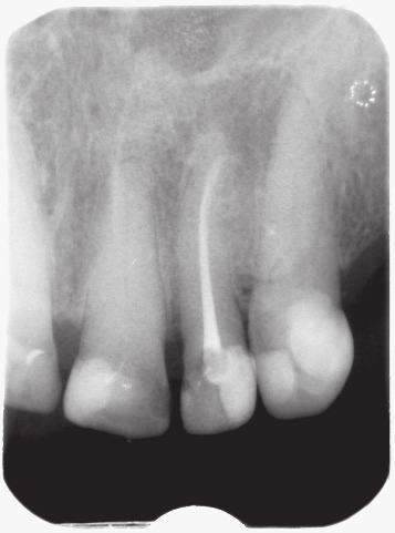 J Stoma 2016; 69, 1 Bołtacz-Rzepkowska E., Tkaczyński P., Łęski M. Fig. 5. Tooth 22 control after eighteen years. Ząb 22 kontrola po 18 latach. Fig. 6. Tooth 22 before repeated root canal treatment.