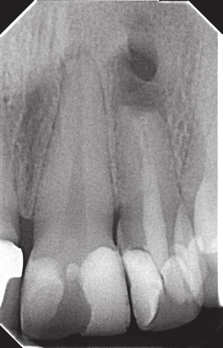 was tenderness to both horizontal and longitudinal percussion along with tenderness to pressure in the apical region. No pathological pocket was present. Radiovisiography (Fig.