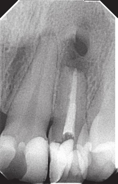 The canal itself was filled in a non-homogenous manner. The diagnosis of exacerbated chronic apical periodontitis was made.