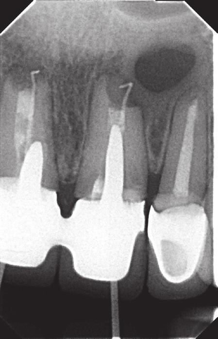 J Stoma 2016; 69, 1 Bołtacz-Rzepkowska E., Tkaczyński P., Łęski M. Fig. 9. Teeth 11 and 21 diagnostic gutta-percha cones placed in pathological pockets.