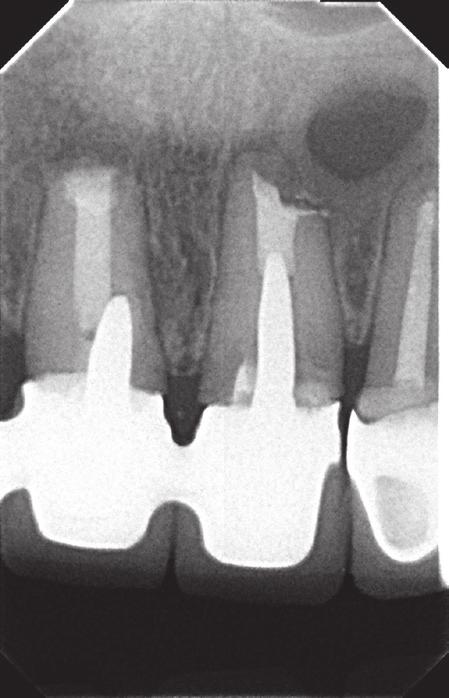 After obtaining consent from the patient another surgical intervention was formulated to eliminate periapical lesions, equalize the apices and perform retrograde preparation and obturation of the