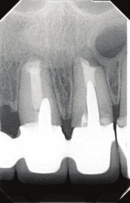 On the next visit infiltration anesthesia was induced with Xylodont 1:50 000 (Molteni, Poland). On reflecting and retracting a full mucoperiosteal flap, absence of labial lamina dura was visible.