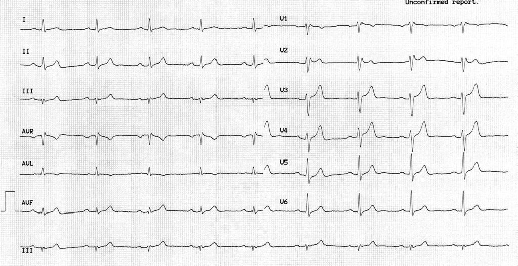 Choroby Serca i Naczyń 2013, tom 10, nr 6 Rycina 2. Obraz elektrokardiogramu u chorego w trakcie kolejnej hospitalizacji.