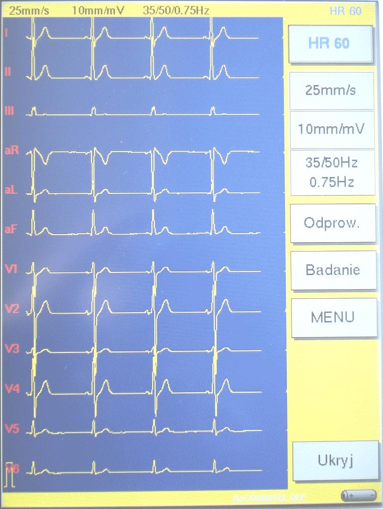 2.7. Wygląd ekranu głównego 4 5 6 7 2 8 9 10 3 1 11 12 Rys. 3. Ekran główny 1. Cecha 2. Nazwa wybranych odprowadzeń 3. Pole wykresu EKG 4. Wartość HR / INOP 5. Wybrana prędkość zapisu 6.