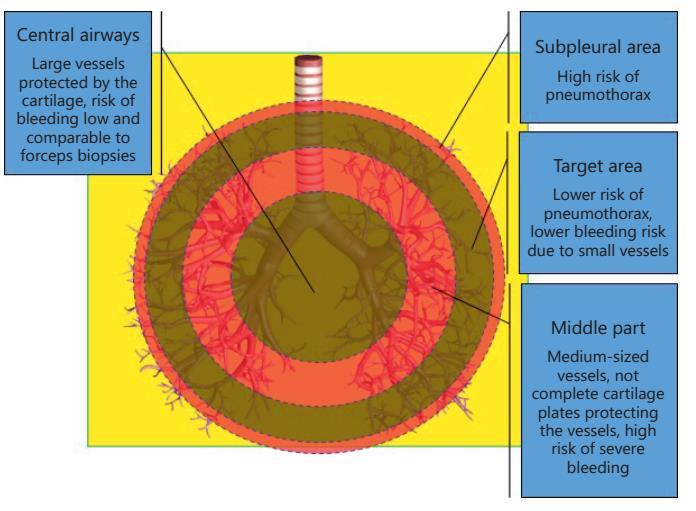 Oskrzela główne Duże naczynia chronione przez chrząstkę - niskie ryzyko krwawienia, porównywalne do TBLB Okolica podopłucnowa Wysokie ryzyko odmy opłucnowej Okolica docelowa Niższe ryzyko odmy