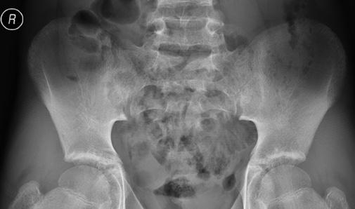 głównie dotyczy zapalnego bólu pleców, który u dzieci jest słabiej nasilony z uwagi na rzadsze zajęcie stawów krzyżowo-biodrowych i kręgosłupa w postaci młodzieńczej (5).