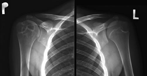 Klasyfikacje i diagnostyka obrazowa młodzieńczych spondyloartropatii C E D Ryc. 7. USG i MR stawu ramienno-łopatkowego 17-letniego chłopca z chorobą Leśniowskiego Crohna:.