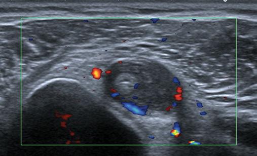 Ultrasonografia: aktywne zapalenie błony maziowej i dwie niewielkie nadżerki głowy kości ramiennej (); zapalenie pochewki ścięgna głowy długiej mięśnia dwugłowego ramienia (C) i głęboka nieaktywna